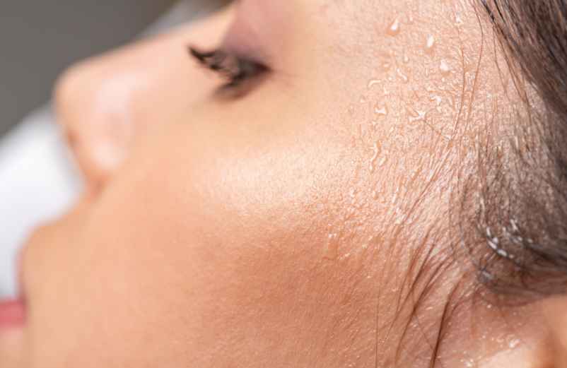 Causes de l'hyperhidrose de la nuque et du cuir chevelu-Le Press Book Causes de l'hyperhidrose de la nuque et du cuir chevelu-Le Press Book