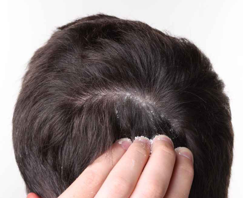 Transpiration excessive de la nuque et cheveux toujours trempés : que faire ?-Le Press Book
